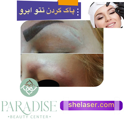 پاک کردن تاتو ابرو با لیزر
