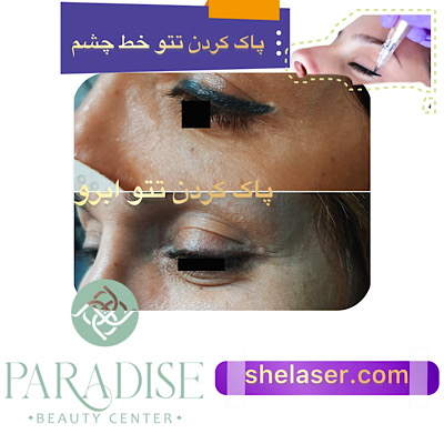 پاک کردن تتو خط چشم