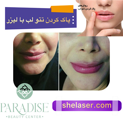 پاک کردن تاتو لب با لیزر
