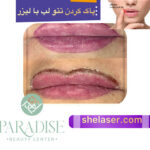 پاک کردن تاتو لب با لیزر