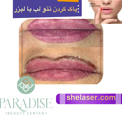 پاک کردن تاتو لب با لیزر