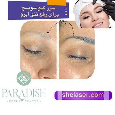 لیزر کیوسوییچ برای رفع تاتو ابرو