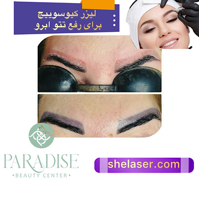 لیزر کیوسوییچ برای رفع تاتو ابرو