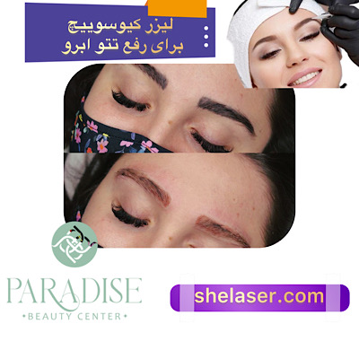 لیزر کیوسوییچ برای رفع تاتو ابرو
