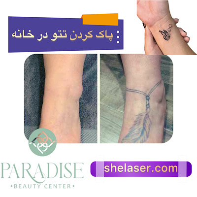 پاک کردن تاتو در خانه