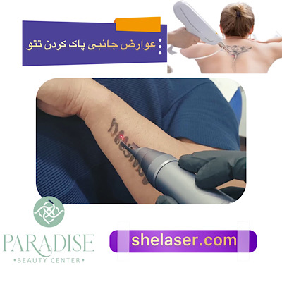 عوارض جانبی پاک کردن تاتو با لیزر