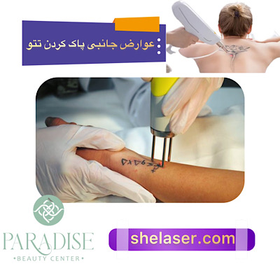 عوارض جانبی پاک کردن تاتو با لیزر