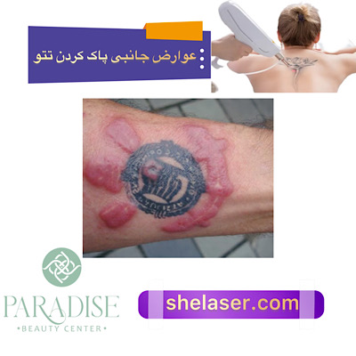 عوارض جانبی پاک کردن تاتو با لیزر