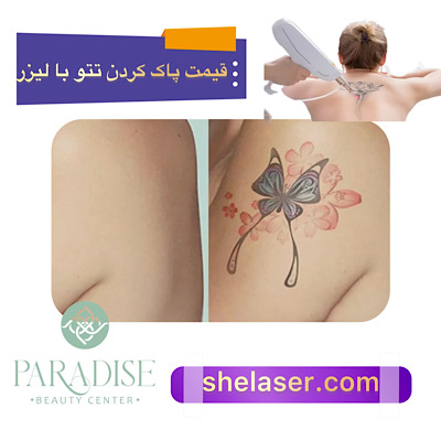 قیمت پاک کردن تتو با لیزر