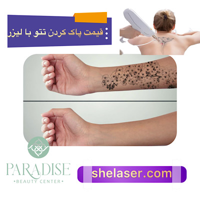 قیمت پاک کردن تتو با لیزر