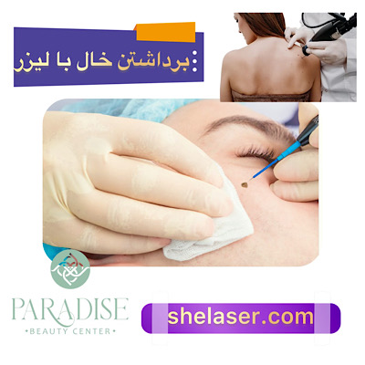 برداشتن خال با لیزر