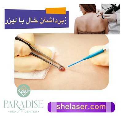 برداشتن خال با لیزر