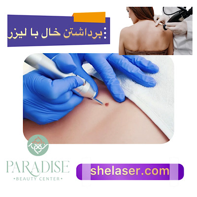 برداشتن خال با لیزر