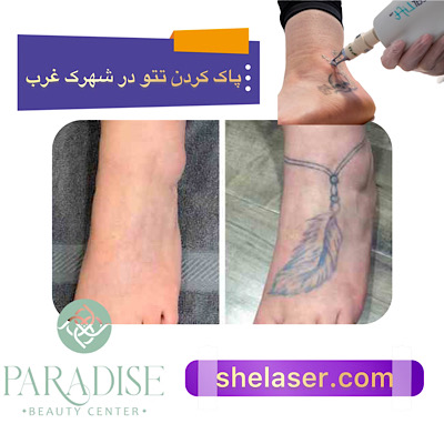 پاک کردن تاتو با لیزر در شهرک غرب