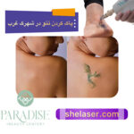 پاک کردن تاتو با لیزر در شهرک غرب