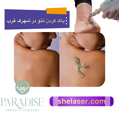 پاک کردن تاتو با لیزر در شهرک غرب