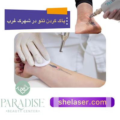 پاک کردن تاتو با لیزر در شهرک غرب