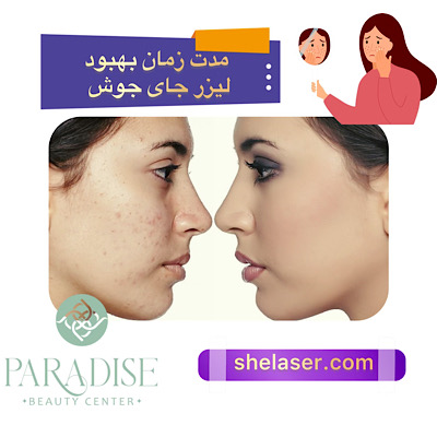 مدت زمان بهبود لیزر جای جوش