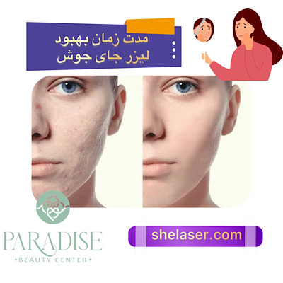 مدت زمان بهبود لیزر جای جوش