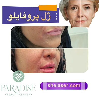 ژل پروفایلو