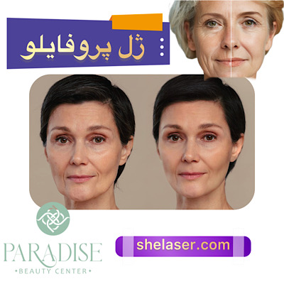 ژل پروفایلو