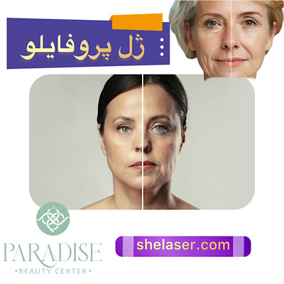 ژل پروفایلو