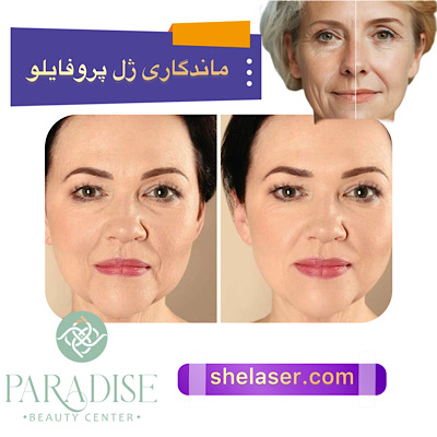 ماندگاری ژل پروفایلو