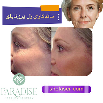 ماندگاری ژل پروفایلو