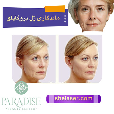 ماندگاری ژل پروفایلو