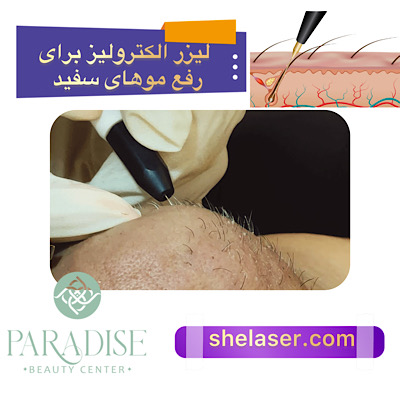  لیزر الکترولیز برای رفع موهای سفید