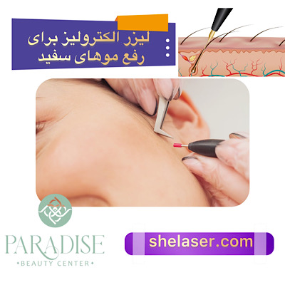  لیزر الکترولیز برای رفع موهای سفید