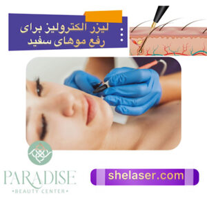 لیزر الکترولیز برای رفع موهای سفید