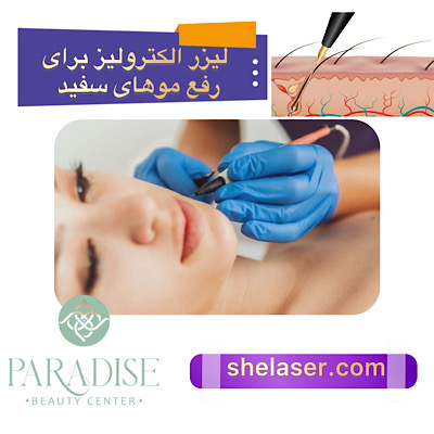  لیزر الکترولیز برای رفع موهای سفید
