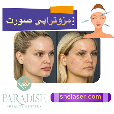 مزوتراپی صورت