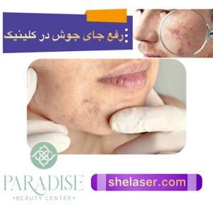 رفع جوش های سر سیاه