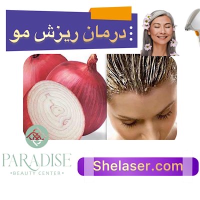  درمان ریزش مو