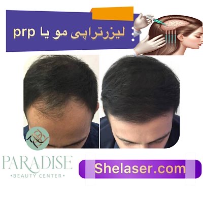 لیزر تراپی مو یا PRP