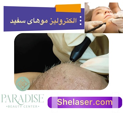 الکترولیز موهای سفید