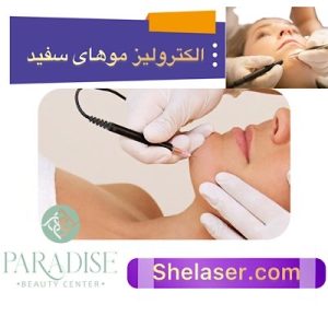 الکترولیز موهای سفید