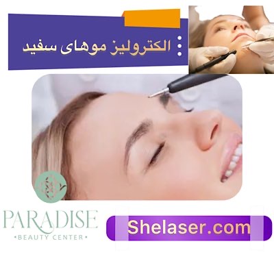 الکترولیز موهای سفید