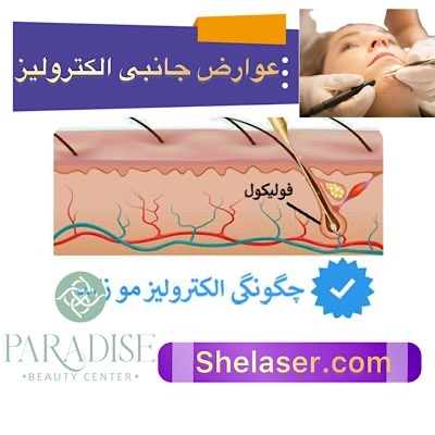 عوارض جانبی الکترولیز