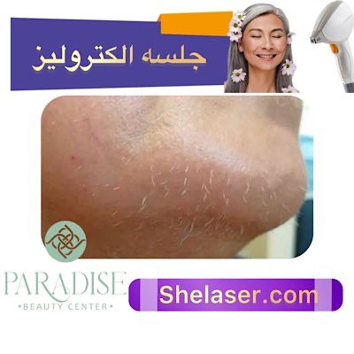 جلسه الکترولیز