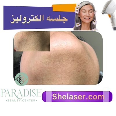 جلسه الکترولیز