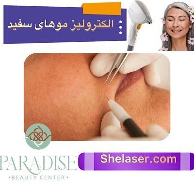 الکترولیز موهای سفید