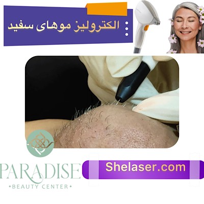 الکترولیز موهای سفید