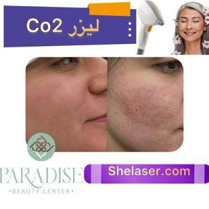لیزر CO2