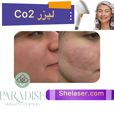 لیزر CO2
