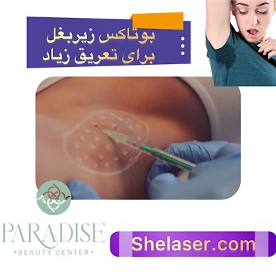 بوتاکس زیر بغل برای تعریق زیاد