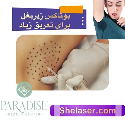 بوتاکس زیر بغل برای تعریق زیاد
