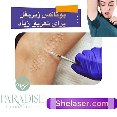 بوتاکس زیر بغل برای تعریق زیاد